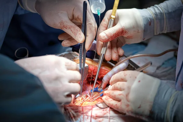 手術室で開かれた心臓手術中に患者を手術する専門医の手の閉鎖.医療介入の概念 — ストック写真