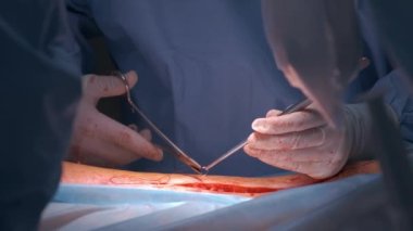 Cerrahi odasında açık ameliyat yapan bir hastayı ameliyat eden doktorların elleri. Sağlık ve tıbbi müdahale kavramı