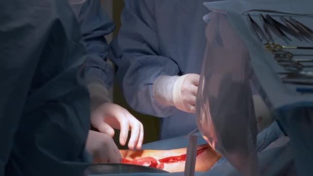 Närbild av läkare händer som driver en patient som utför öppen skär kirurgi i kirurgiskt rum. Koncept för hälso- och sjukvård — Stockvideo