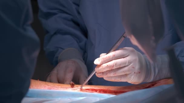 医生在手术室为施行开刀手术的病人进行手部手术。保健和医疗干预概念 — 图库视频影像