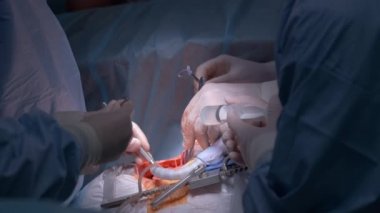 Profesyonel doktorlardan oluşan bir ekip ameliyathanede açık kalp ameliyatı yapan bir hastayı ameliyat ediyor. Sağlık ve tıbbi müdahale kavramı.