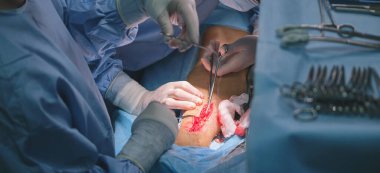 Cerrahi odasında açık ameliyat yapan bir hastayı ameliyat eden doktorların elleri. Sağlık ve tıbbi müdahale kavramı.