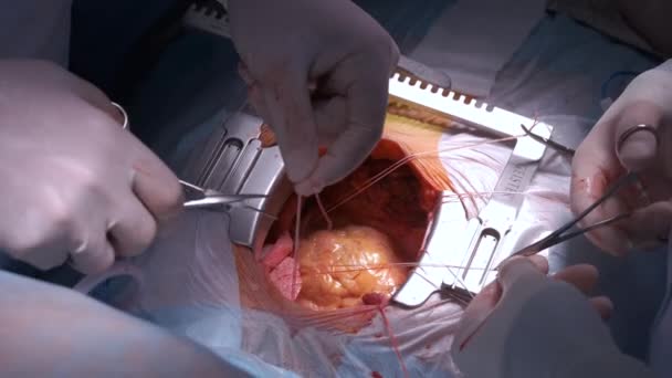 Закрытие Профессиональных Рук Врача Оперирующих Пациента Время Операции Открытом Сердце — стоковое видео