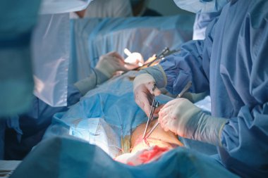 Profesyonel doktorlardan oluşan bir ekip cerrahi odasında açık ameliyat yapan bir hastayı ameliyat ediyor. Sağlık ve tıbbi müdahale kavramı.
