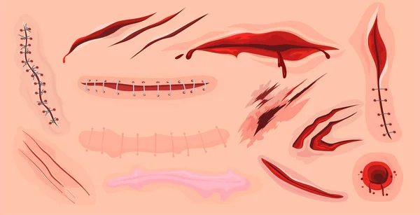 人間の皮膚の傷 ウェブデザインのための平らなセットを切断し 血の傷 体組織分離ベクトルイラストコレクションで漫画の破裂 外傷と外傷の概念 — ストックベクタ