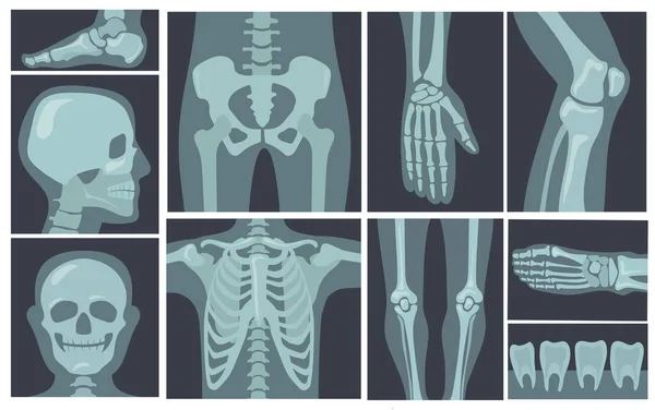 Φωτοβολίδες Ακτίνων Του Ανθρώπινου Σώματος Εικονογράφηση Φορέα Κινουμένων Σχεδίων Ακτινογραφίες — Διανυσματικό Αρχείο