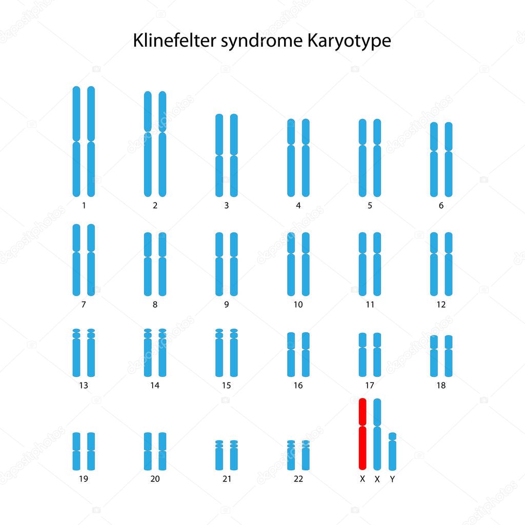 Klinefelter syndrome (XXY) human karyotype