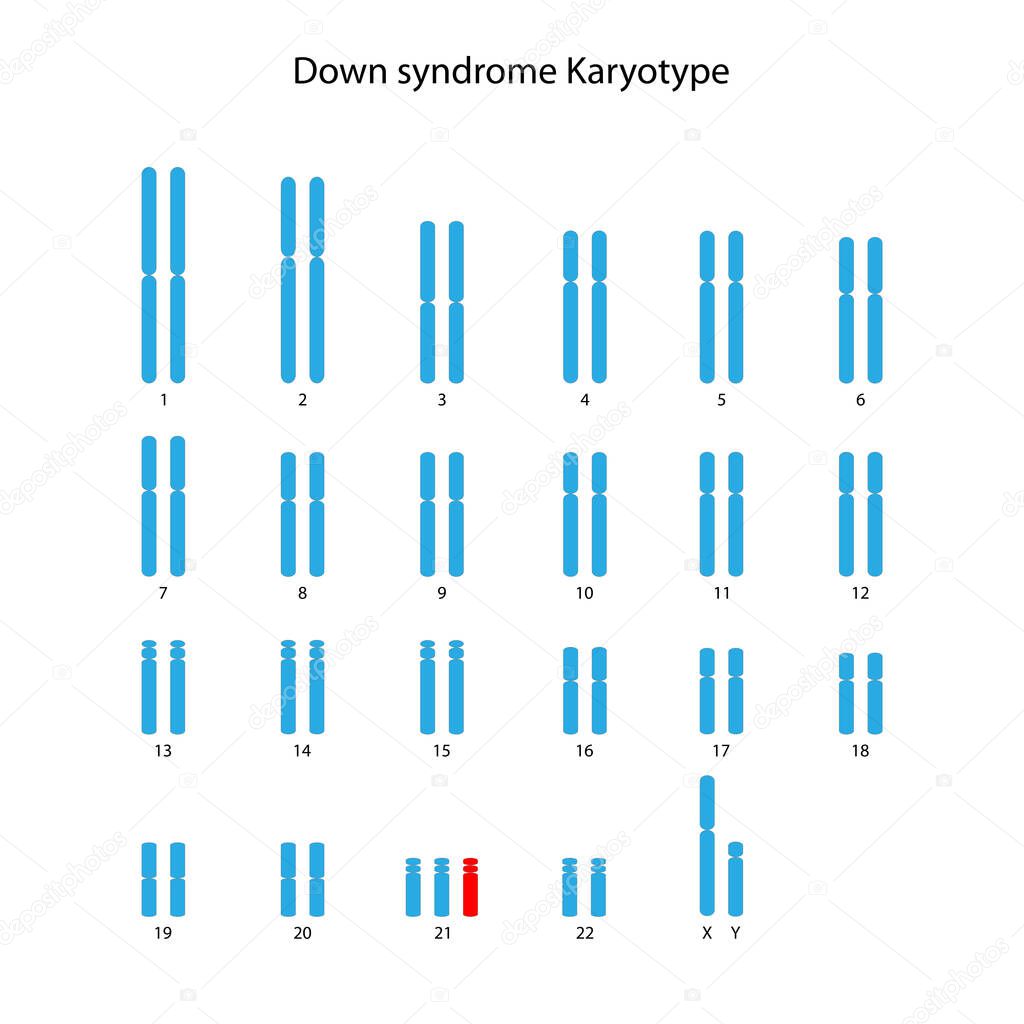Down syndrome (trisomy 21) human karyotype