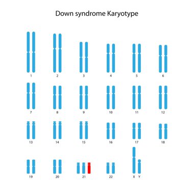 Down sendromu (trisomi 21) insan karyotipi