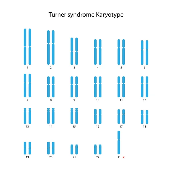 Turner Sendromu Insan Karyotipi — Stok fotoğraf