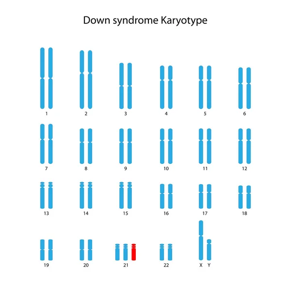 Downův Syndrom Trizomie Lidský Karyotyp — Stock fotografie