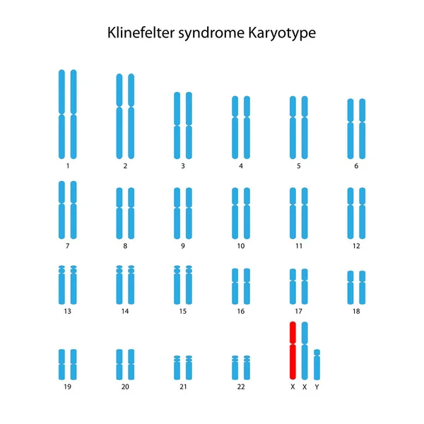 Klinefelterův Syndrom Xxy Lidský Karyotyp — Stock fotografie