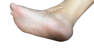 Beyaz arka planda izole edilmiş ayakların kaba tabanları