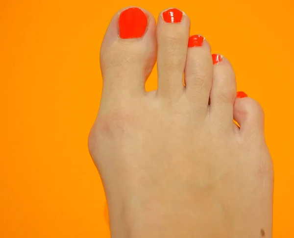 Hallux valgus, ağrılı bükülmüş baş parmak