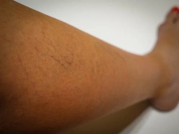 Διασταλμένα Και Ραγισμένα Αιμοφόρα Αγγεία Στο Πόδι — Φωτογραφία Αρχείου