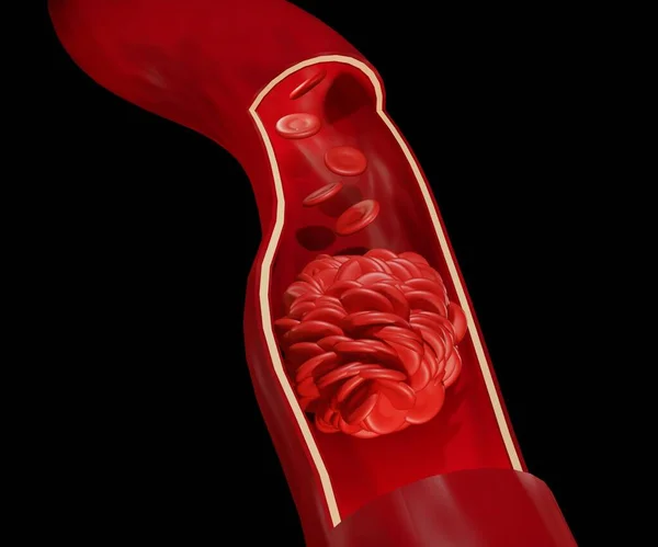 Coágulo Sangre Trombo Producto Final Etapa Coagulación Sangre Hemostasia — Foto de Stock