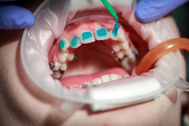 Diş teli takmadan önce dişlere sürtünme, ergenlikte eğri dişler, diş bakımı, dişçi muayenesi -.