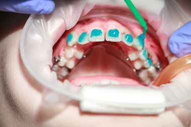 Diş teli takmadan önce dişlere sürtünme, ergenlikte eğri dişler, diş bakımı, dişçi muayenesi -.