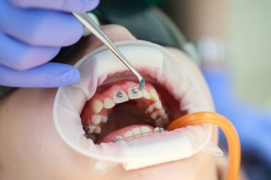 Üst dişlere diş teli takılacak. Bir ortodontist tarafından tedavi. Diş tellerine odaklan. Seçici Keskinlik.