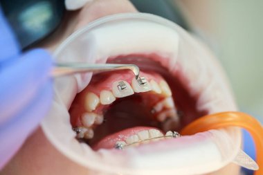 Üst dişlere diş teli takılacak. Bir ortodontist tarafından tedavi. Diş tellerine odaklan. Seçici Keskinlik.