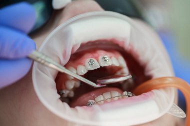 Üst dişlere diş teli takılacak. Bir ortodontist tarafından tedavi. Diş tellerine odaklan. Seçici Keskinlik.