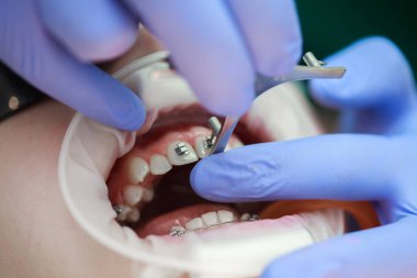 Üst dişlere diş teli takılacak. Bir ortodontist tarafından tedavi. Diş tellerine odaklan. Seçici Keskinlik.