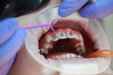 Üst dişlere diş teli takılacak. Bir ortodontist tarafından tedavi. Diş tellerine odaklan. Seçici Keskinlik.