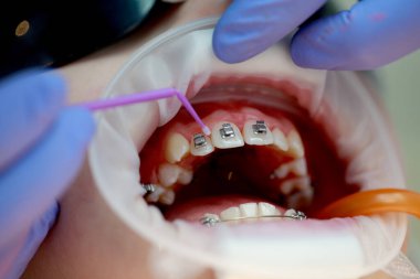 Üst dişlere diş teli takılacak. Bir ortodontist tarafından tedavi. Diş tellerine odaklan. Seçici Keskinlik.