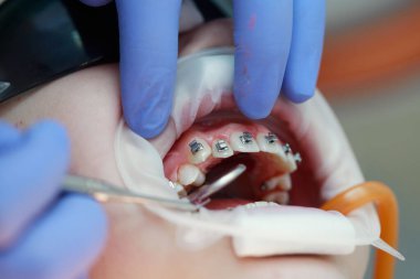 Üst dişlere diş teli takılacak. Bir ortodontist tarafından tedavi. Diş tellerine odaklan. Seçici Keskinlik.