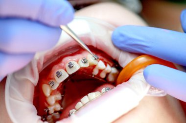 Üst dişlere diş teli takılacak. Bir ortodontist tarafından tedavi. Diş tellerine odaklan. Seçici Keskinlik.