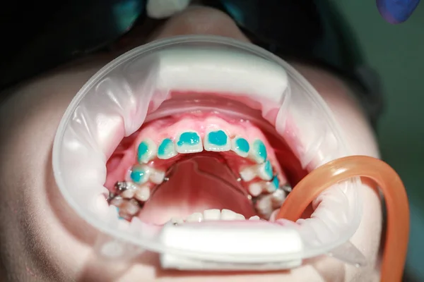 歯に歯をエッチングする前に ブレース 10代の曲がった歯 歯の整列 歯科医による治療 歯医者 — ストック写真