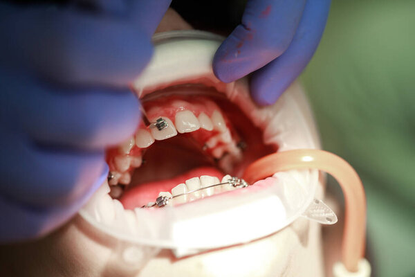 Installation of braces on the upper teeth. Treatment by an orthodontist. Focus on braces. Selective Sharpness.