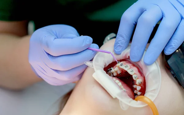 Installation Accolades Sur Les Dents Supérieures Traitement Par Orthodontiste Concentrez — Photo
