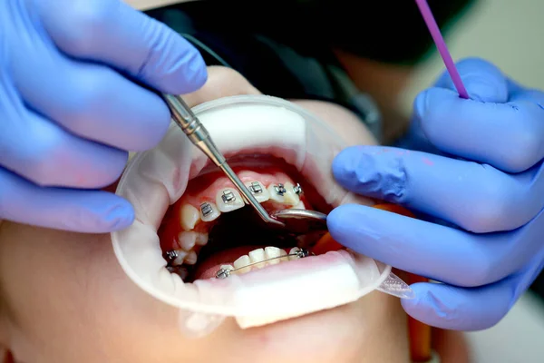 Installation Accolades Sur Les Dents Supérieures Traitement Par Orthodontiste Concentrez — Photo