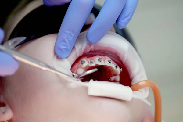 Встановлення Брекетів Верхніх Зубах Лікування Ортодонта Зосередьтеся Брекетах Вибіркова Різкість — стокове фото
