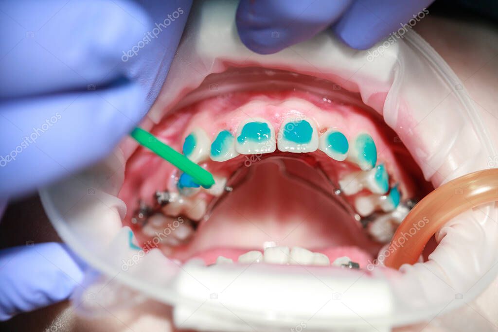 Ge grabado en los dientes antes de instalar frenos, dientes torcidos en