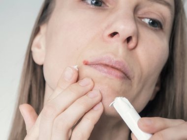 Dudaklarında virüs olan bir kadının yüzü uçuk, merhemle tedavi, yakın çekim. Uçuk tedavisi. İlkbaharda hastalığın iyileşmesi. 