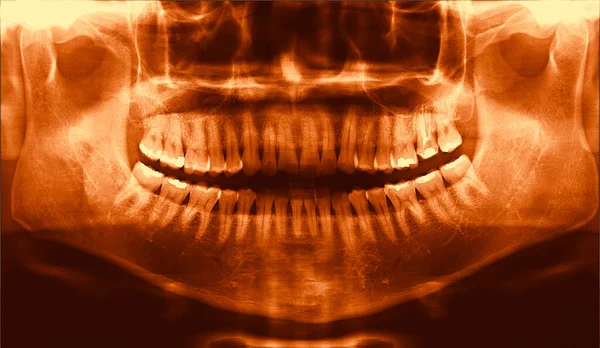 Full Arch Wide Maxillary Male Dental Panoramic Ray Radiography — Stock Photo, Image