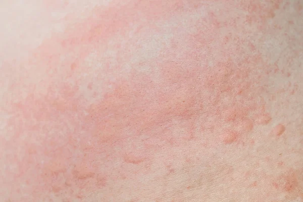 Αλλεργικό Δερματικό Εξάνθημα Κνησμώδες Θερμότητα Δέρμα Κόκκινη Κουκίδα Closeup Δερματικό — Φωτογραφία Αρχείου
