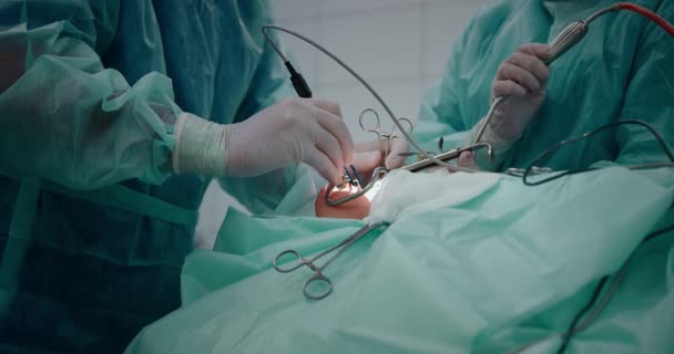 医師は扁桃腺を除去するために小児外科手術を行います。扁桃腺切除. — ストック動画