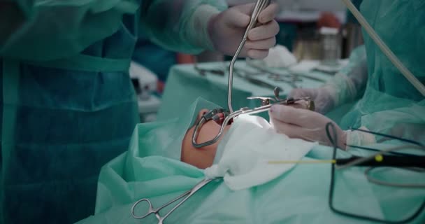 Lékař provádí pediatrickou chirurgickou operaci k odstranění mandlí. Mandletomie. — Stock video