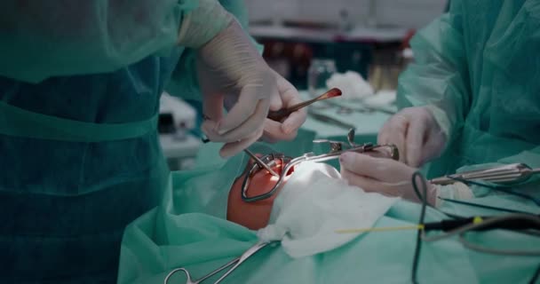 Doktor bademcikleri almak için pediatrik cerrahi bir operasyon yapıyor. Bademcik ameliyatı.. — Stok video