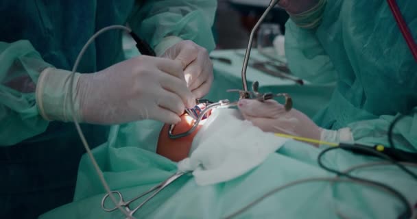 Врач проводит педиатрическую хирургическую операцию по удалению миндалин. Тонзиллэктомия. — стоковое видео