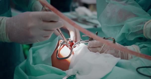 Lékař provádí pediatrickou chirurgickou operaci k odstranění mandlí. Mandletomie. — Stock video
