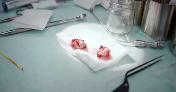 Der Arzt führt eine kinderchirurgische Operation durch, um die Mandeln zu entfernen. Tonsillektomie. — Stockvideo
