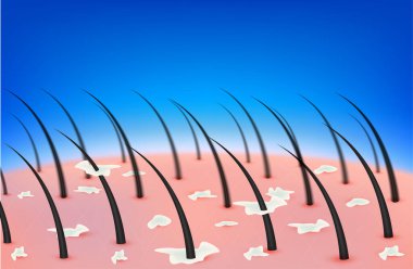 Saç kepeği ve kafa derisi. Dermatit, bakteri, mantar ya da başındaki sivilcelerden kaynaklanır. İnsan derisinin katmanları. Tıbbi güzellik konsepti. 3 boyutlu gerçekçi vektör. Güzellik kliniği reklamlarında kullanılır..