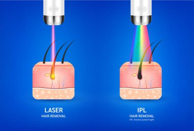 Kıllı deri katmanları anatomi. Lazer ve IPL ışığı (Yoğun Pulsed Light) saç kesimi. İstenmeyen dış görünüş cildi yumuşatır. Güzellik reklamlarında kullanılır. Tıp bilimi konsepti. 3B Gerçekçi Vektör.