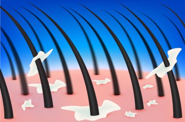 Saç kepeği ve kafa derisi. Dermatit, bakteri, mantar ya da başındaki sivilcelerden kaynaklanır. İnsan derisinin katmanları. Tıbbi güzellik konsepti. 3 boyutlu gerçekçi vektör. Güzellik kliniği reklamlarında kullanılır..