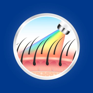 IPL ışığı (Yoğun Pulsed Light) ve lazer tüylerinin istenmeyen bir şekilde alınması deriyi pürüzsüz yapar. Tıbbi güzellik konsepti. 3D gerçekçi vektör EPS10. Gümüş etiketler ürün etiketi tasarımı için kullanılır.