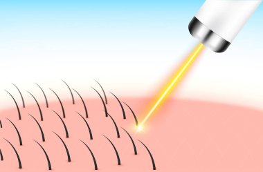 Lazerle alınması istenmeyen tüyleri aldırmak deriyi pürüzsüz yapar. Tıbbi güzellik konsepti. 3D gerçekçi vektör EPS10. Gümüş etiketler ürün etiketi tasarımı için kullanılır.